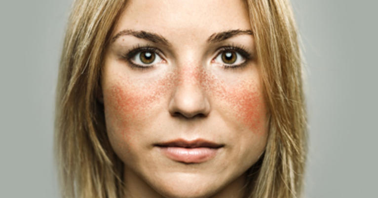 Lupus-Face-Rash
