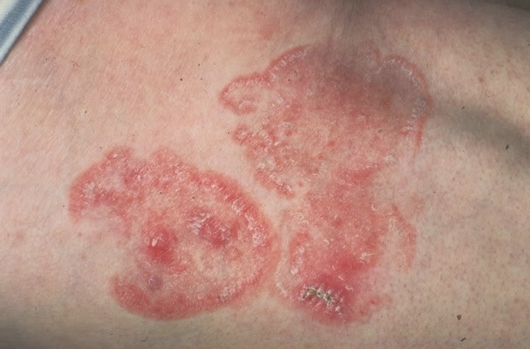 spoggoeidis-mikitiasi