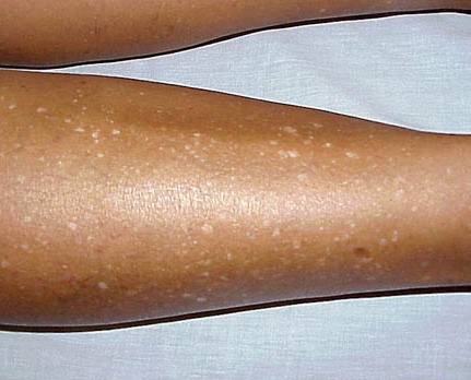 stagonoeidis-upomelanosi